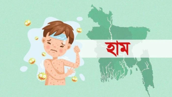 হামের উপসর্গে আরও ৮ শিশুর মৃত্যু, ৮৭ দিনে প্রাণহানি ৬৩৯